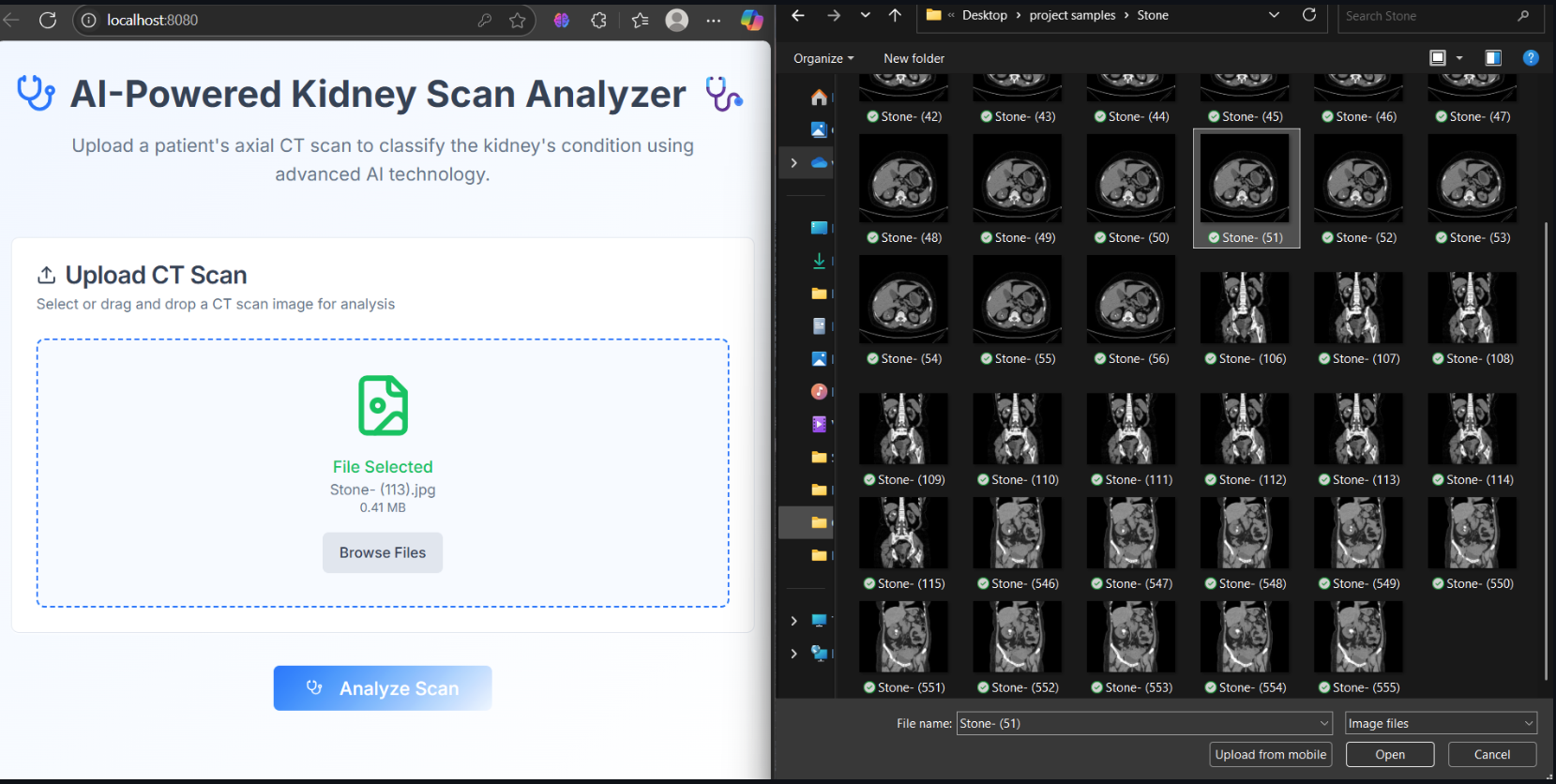 Kidney Stone Detection AI